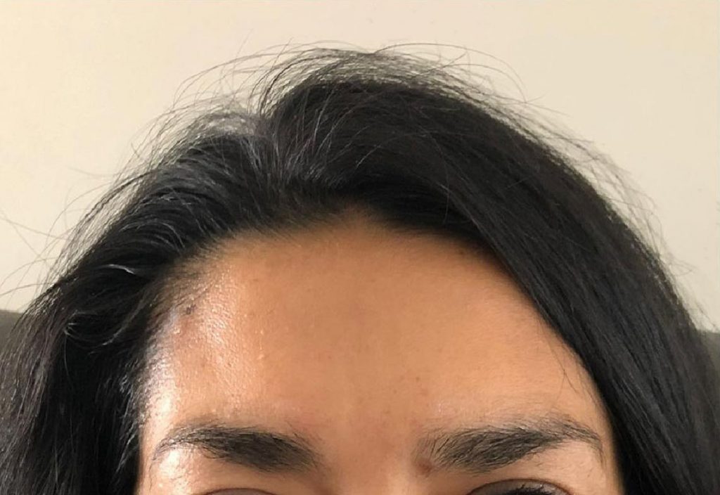 After of a wrinkle treatment